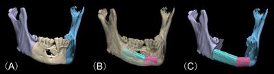 Deviation Analyses of Computer-Assisted, Template-Guided Mandibular Reconstruction With Combined Osteotomy and Reconstruction Pre-Shaped Plate Position Technology: A Comparative Study